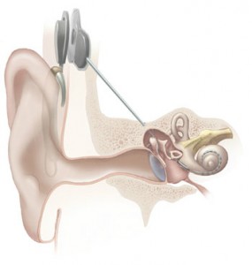 Graphic showing what a cochlear implant looks like