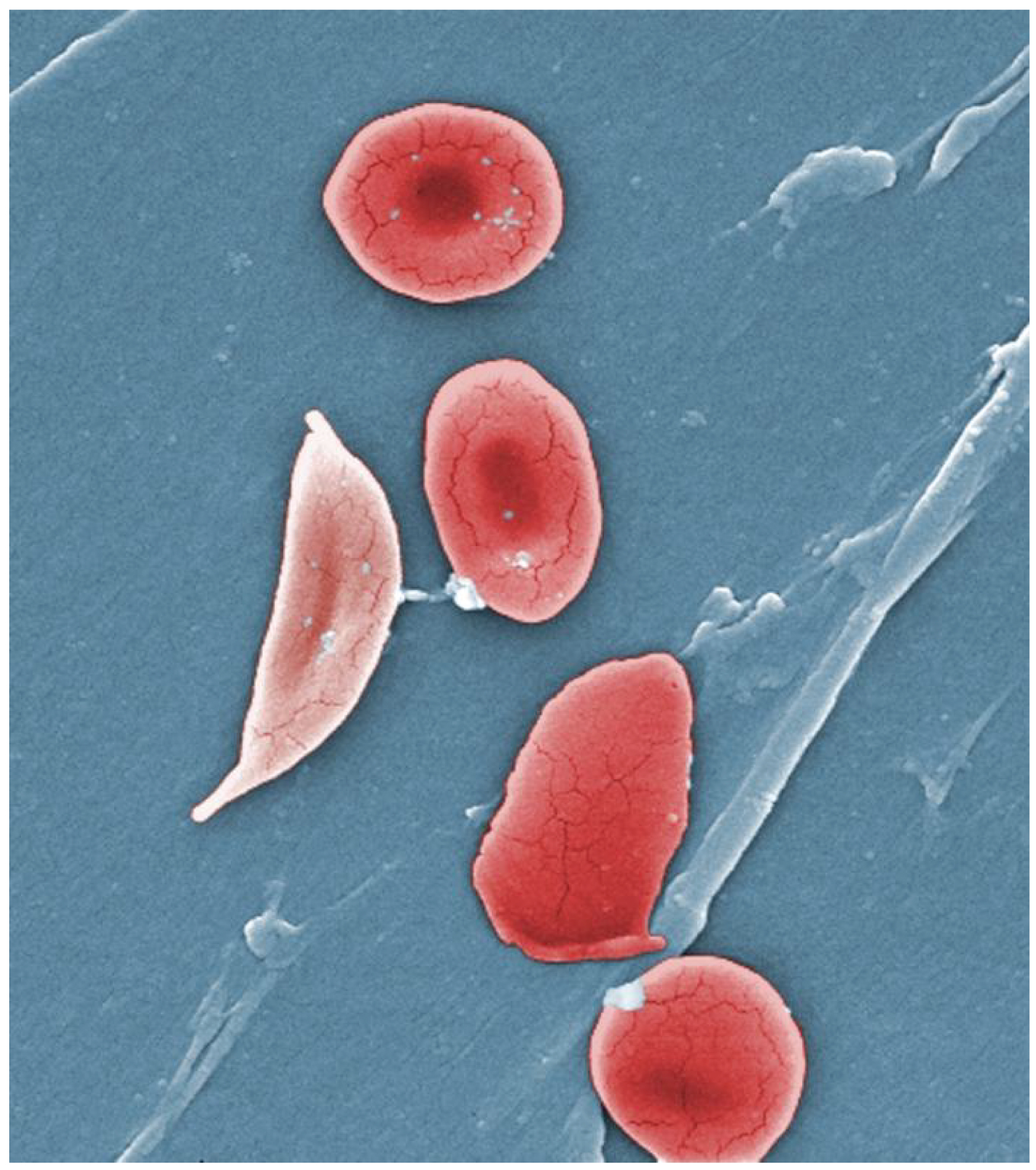 Normal blood cells next to a sickle blood cell, coloured scanning electron microscope image