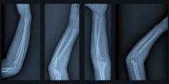 A broken arm x-ray