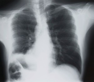 Nearly one in three lung cancer patients in the UK dies within three ...